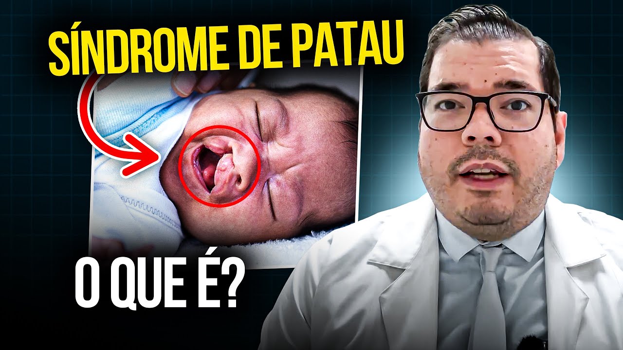 Síndrome de Patau - Trissomia do Cromossomo 13