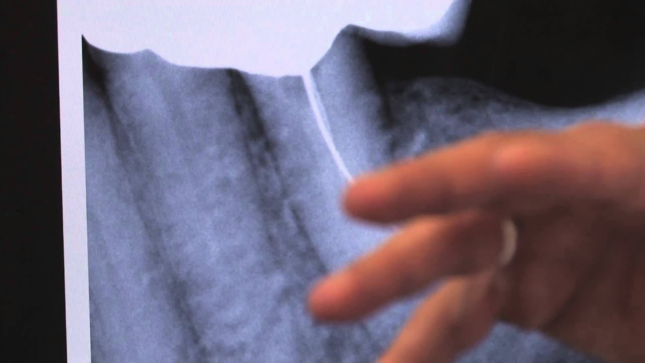 Fill at Bifurcation Area