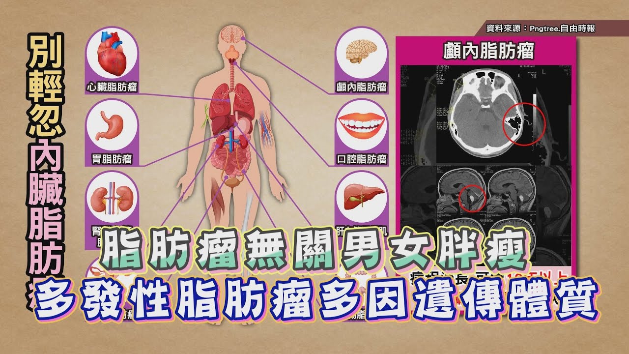 脂肪瘤無關男女胖瘦 多發性脂肪瘤多因遺傳體質 健康2.0 精華 王健宇醫師 @tvbshealth20 ​