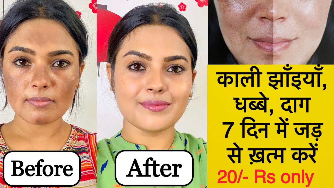 झाइयों से छुटकारा पाये सिर्फ़ 7 दिनों में ॥ Reduce Melasma, Pigmentation, Discolouration, Blackspots