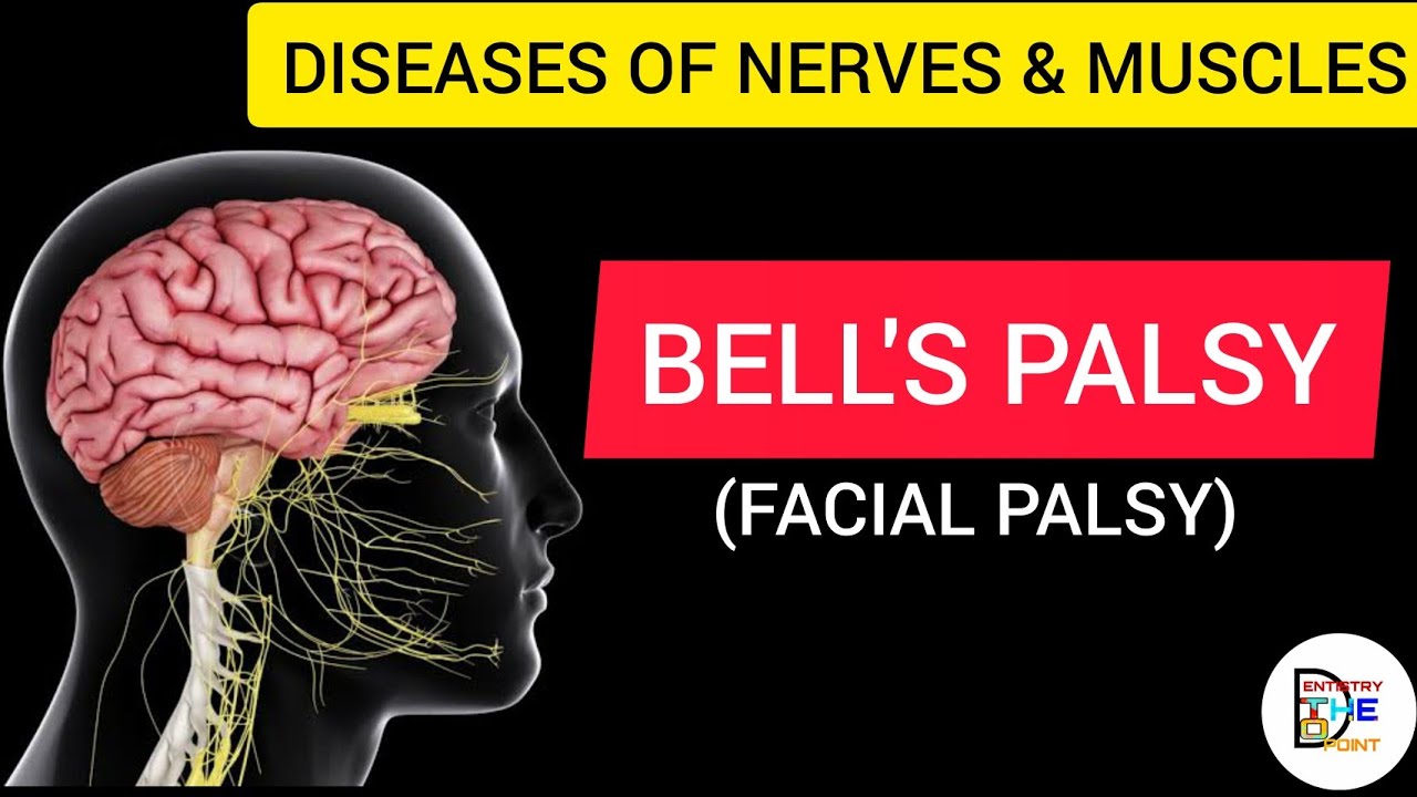 FACIAL PALSY/ BELLS PALSY