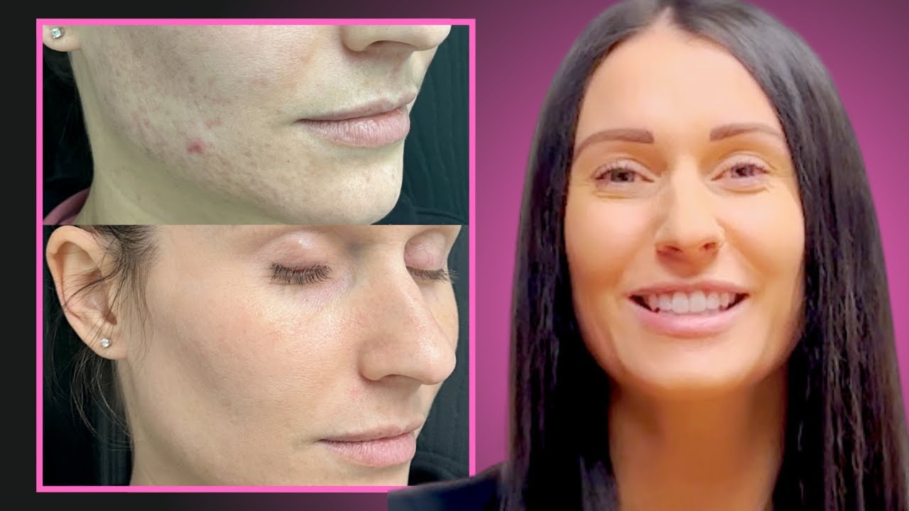 The MedAesthetics Acne Scar Program
