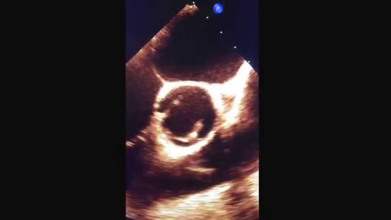 Bicuspidie aortique de type I vue en ETO 2D et 3D