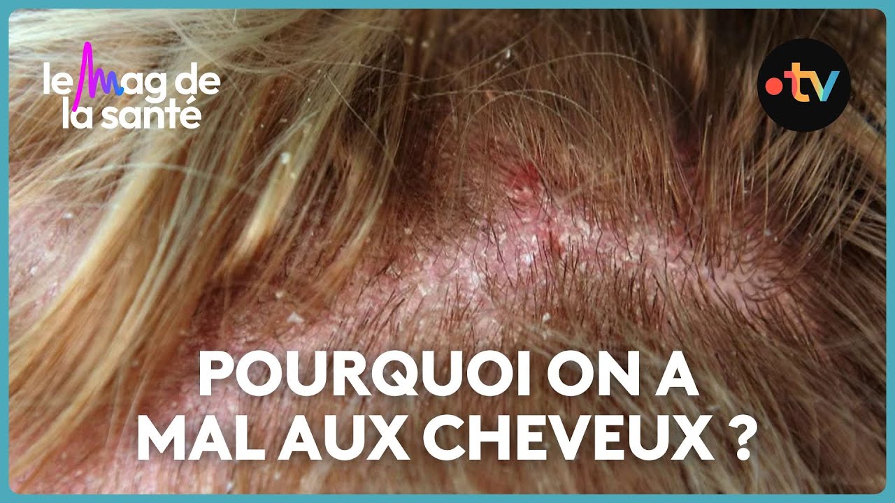 Trichodynie : nos conseils pour soulager les douleurs du cuir chevelu
