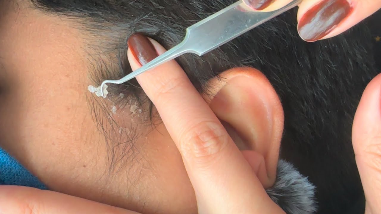Dry Scalp Scratching ASMR | Dandruff Removal 
