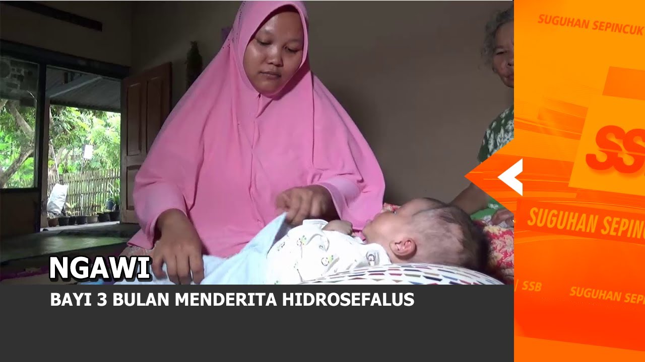 NGAWI - Bayi 3 Bulan Menderita Hidrosefalus