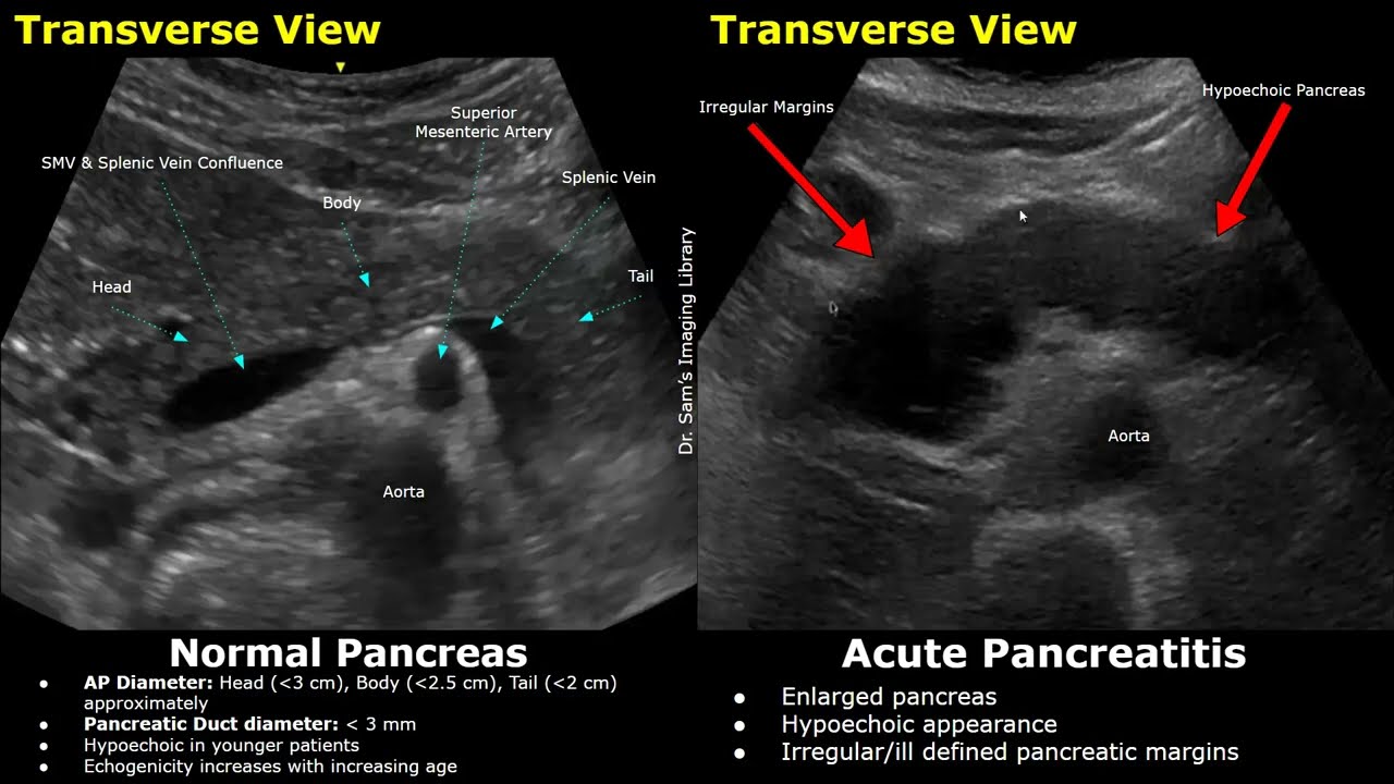 Pancreas Ultrasound Normal Vs Acute Pancreatitis Imaging Findings | Abdominal USG Pancreas Images