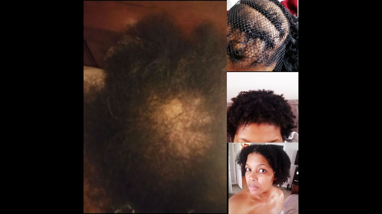 How I Was Diagnosed and Treated For THREE Different Types of Severe Hair Loss