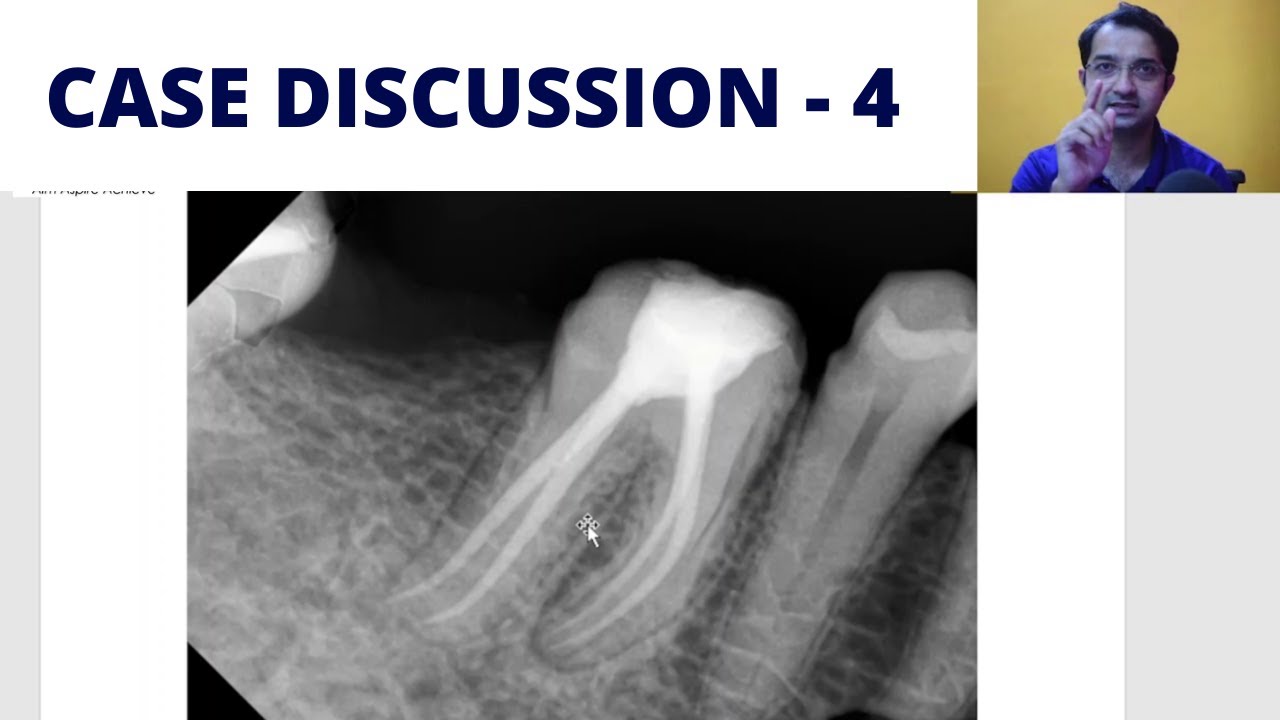 Short Case Discussion | Reading X-rays | Aspire32
