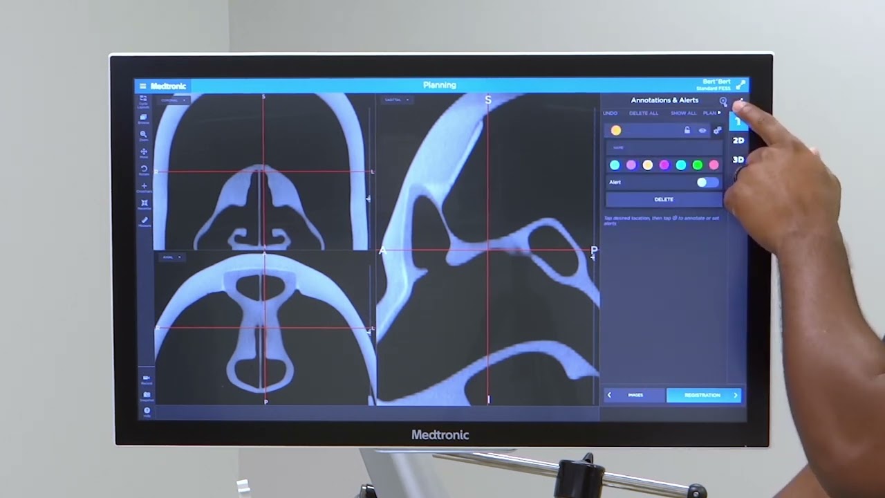 StealthStation™ ENT SW 2.1 Presurgical planning: measure tool, annotations and alerts