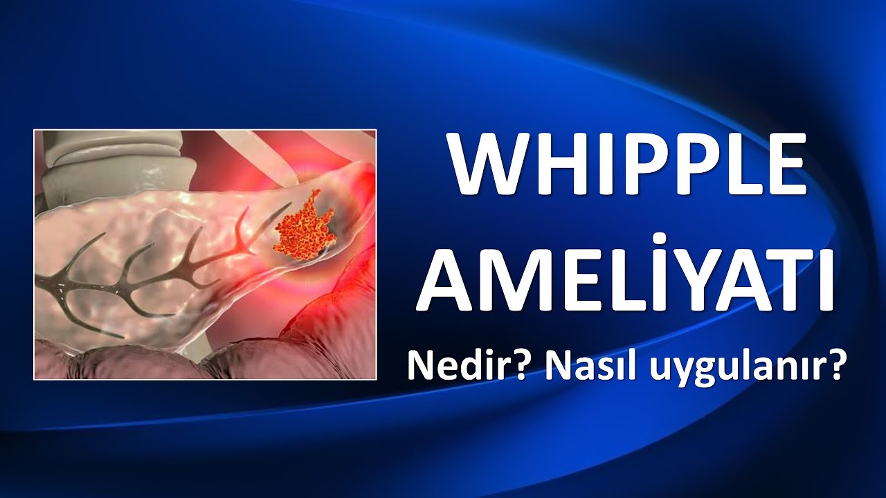 WHIPPLE AMELİYATI NEDİR?