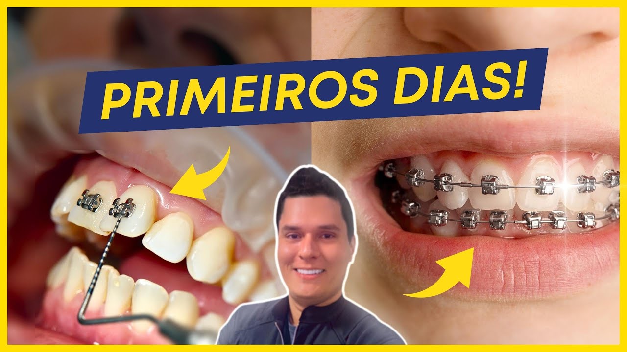 7 CUIDADOS INDISPENSÁVEIS PARA TER APÓS COLOCAR APARELHO!