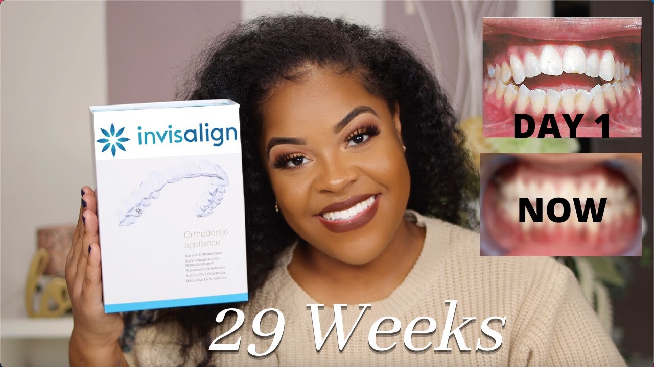 Invisalign Journey | Open Bite | 29 Week Update | Part 4