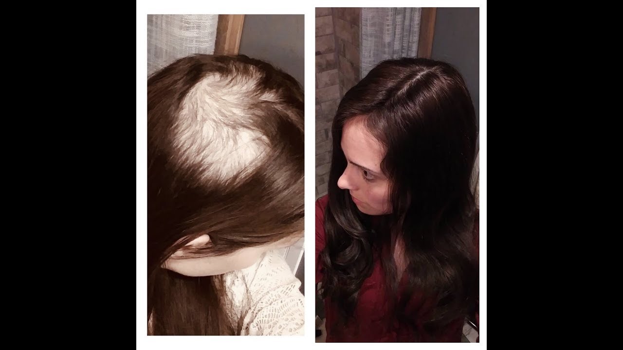 Bethany BEAT Trichotillomania Pt.2 PERFECTFRINGE SILK REVIEW Thin Thinning Hair Loss Solution Women