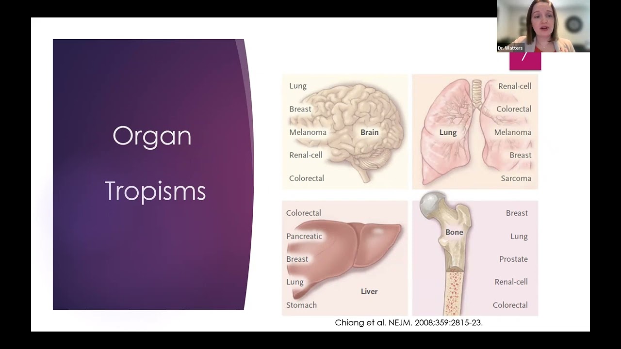 MBC Impact Series: Bone Metastasis Overview and Potential Treatments