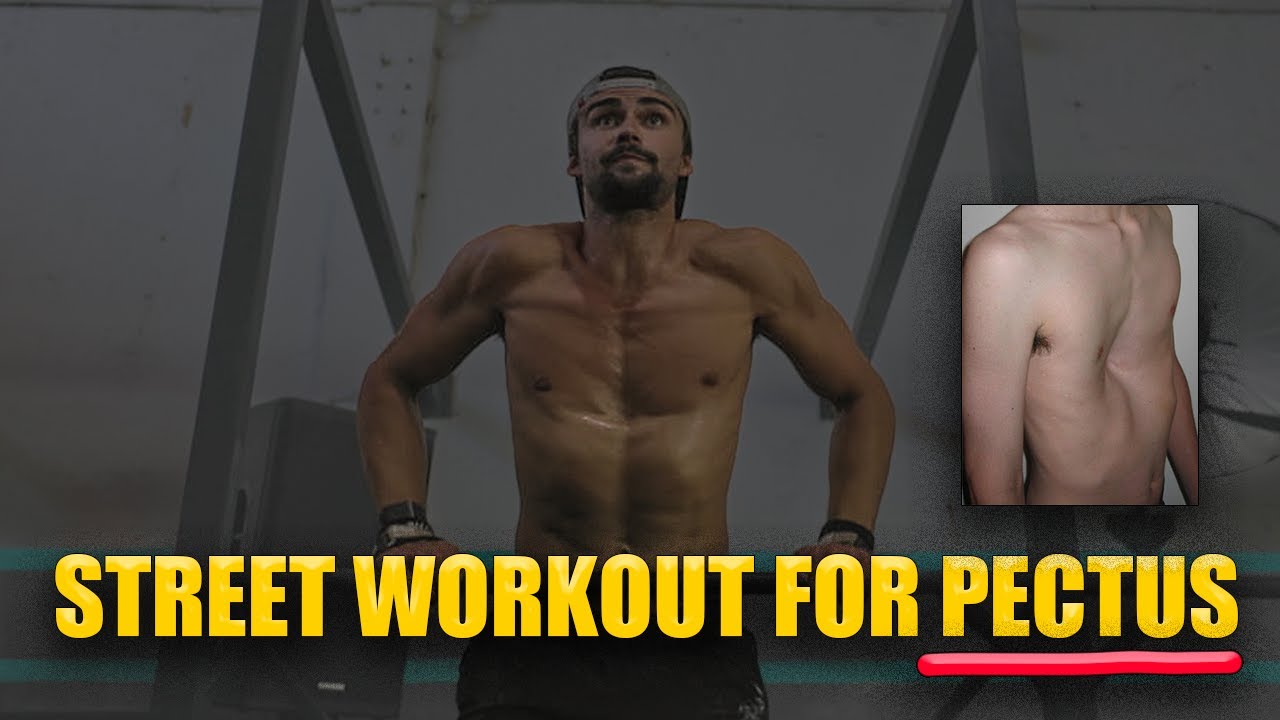 Bodyweight Street Workout For Pectus Excavatum