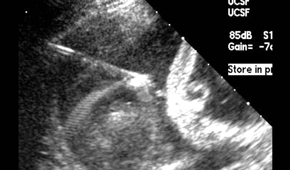 UCSF Radiology: Ultrasound of a Fetal Hydrothorax Drainage
