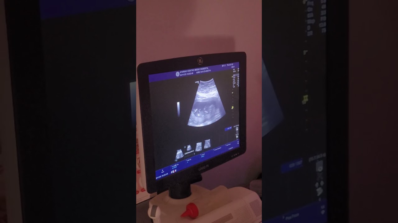Ultrassom Morfológica de primeiro trimestre com 13 semanas e 3 dias. Palpite de 90% do sexo.