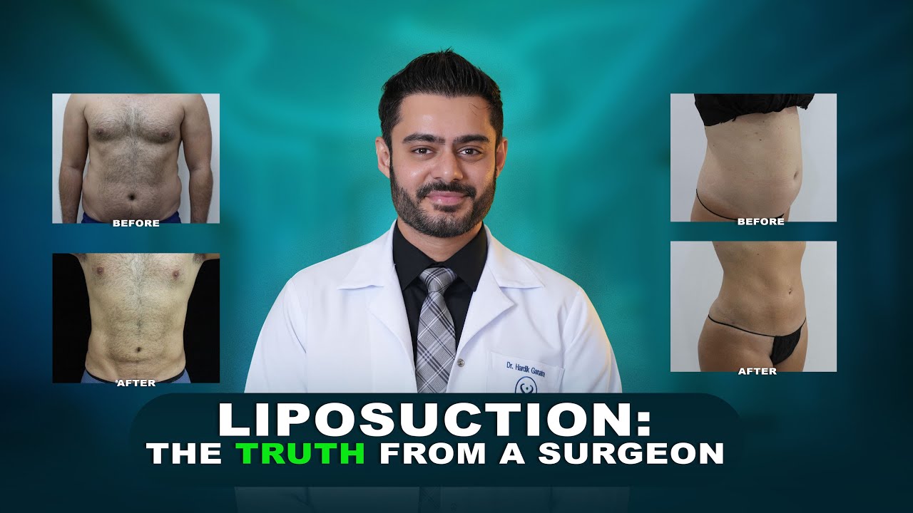 Liposuction Explained: A Surgeon's Honest Guide | Dr. Hardik Ganatra