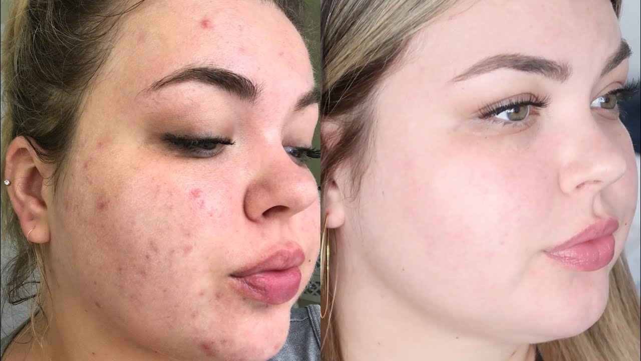 MY ACCUTANE JOURNEY | BEFORE AND AFTER, SIDE EFFECTS & MORE