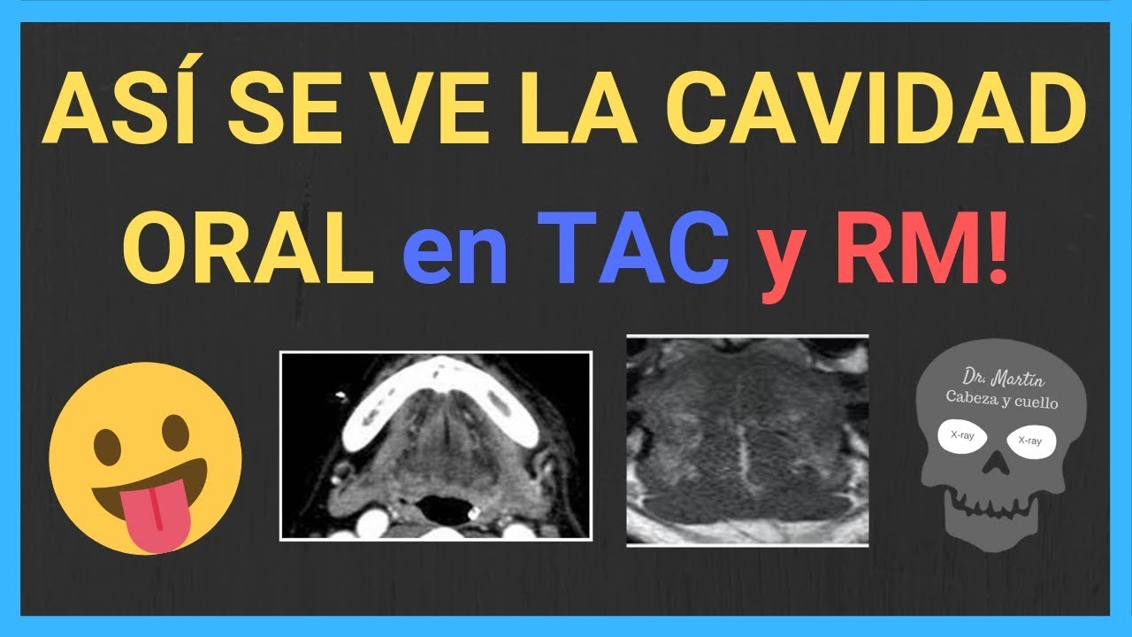 👅CAVIDAD ORAL: anatomía (TAC y RM)