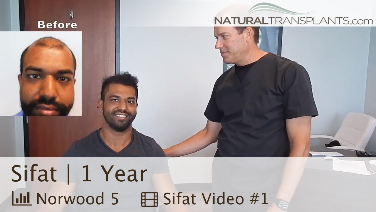 Balding Male Hair Transplant 1 Year Results | Dr. Harold Siegel of Natural Transplants (Sifat)