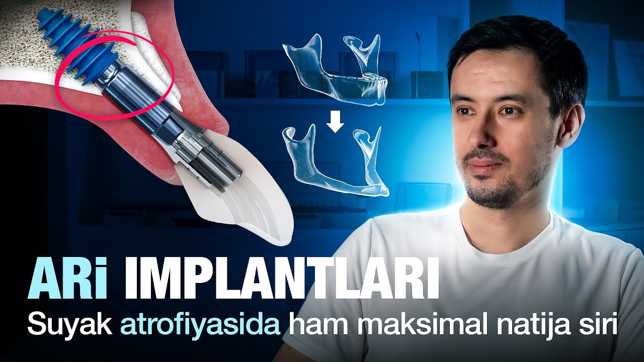 ARi implantlari: Suyak atrofiyasida maksimal natija siri