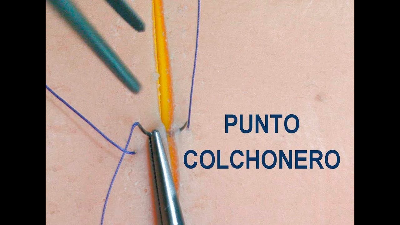 Suturas quirúrgicas. PUNTOS COLCHONEROS. Curiosos y absolutamente necesarios. No son tan fáciles.