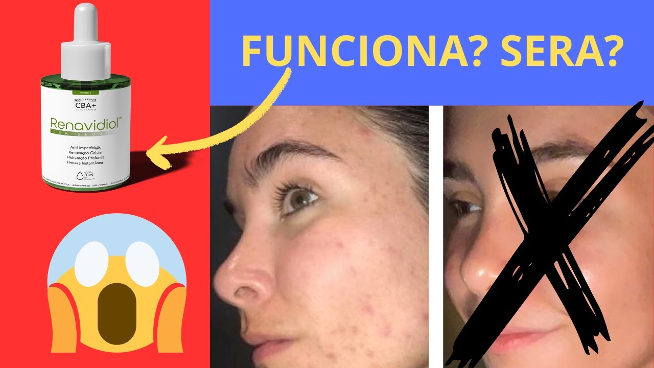 Renavidiol  Canabidiol S&eacute;rum &eacute; Confi&aacute;vel? Renavidiol Cannabinodiol &eacute; Seguro? Veja este video