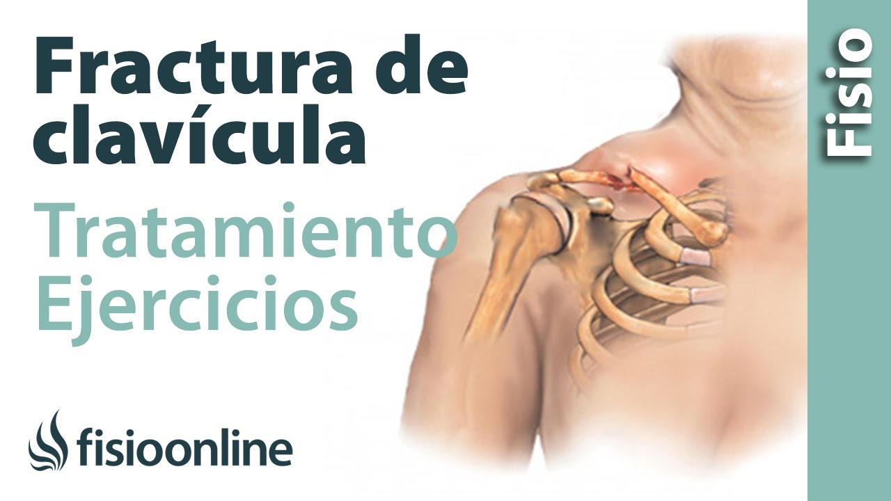 FRACTURA de CLAVÍCULA. Rehabilitación, ejercicios y tiempo de RECUPERACIÓN