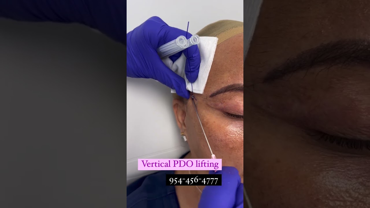 Non surgical. PDO. Thread lift. Elite Medical Spa. Boca Raton. 954-456-4777.  #shorts