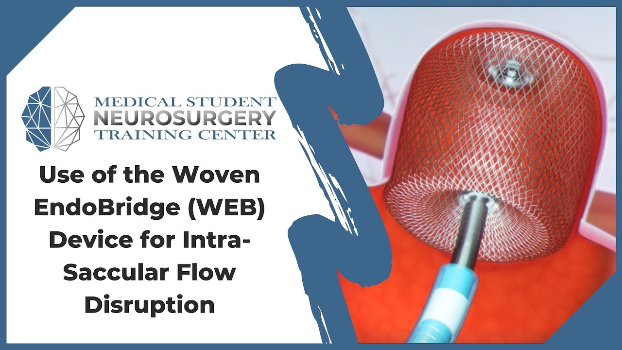 Применение устройства Woven EndoBridge (WEB) для нарушения внутрисосудистого кровотока.