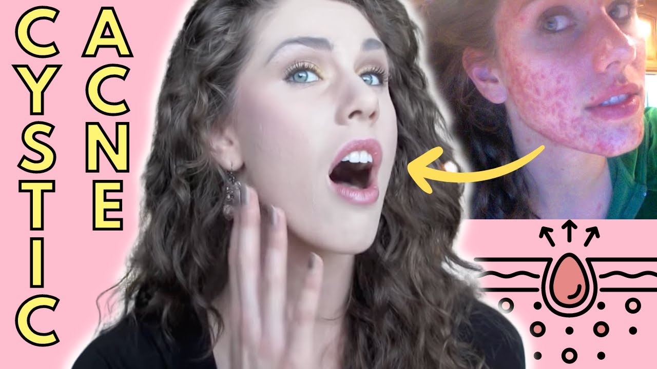 What Is Cystic Acne? Causes? Treatment? | Cassandra Bankson