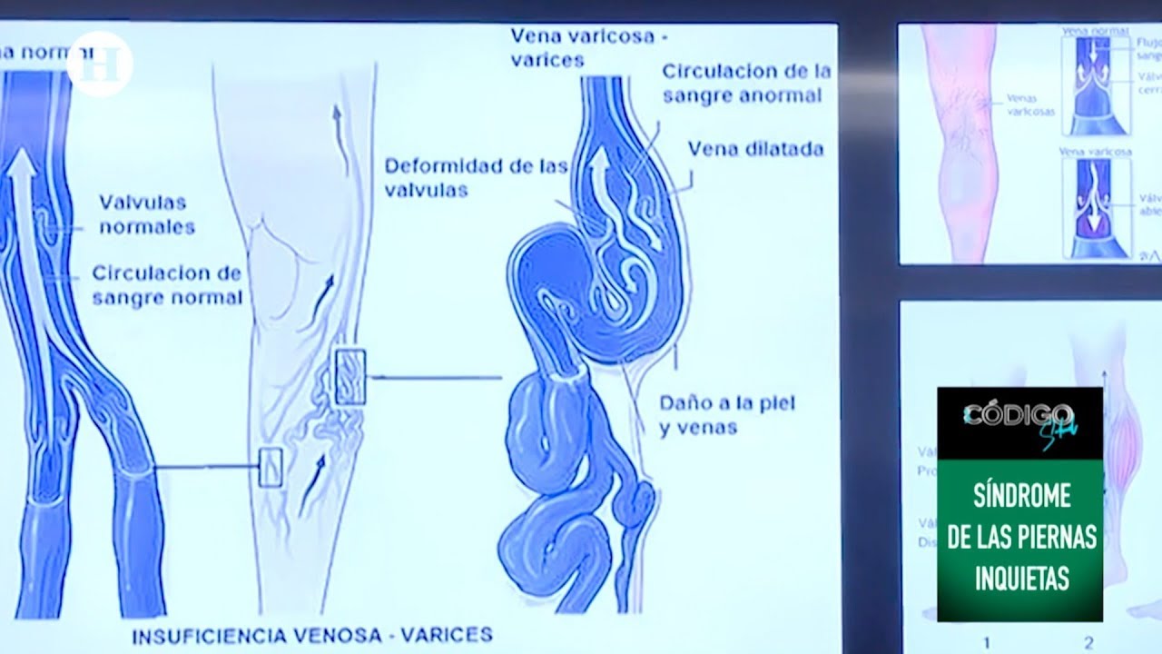 Cómo identificar el síndrome de piernas inquietas