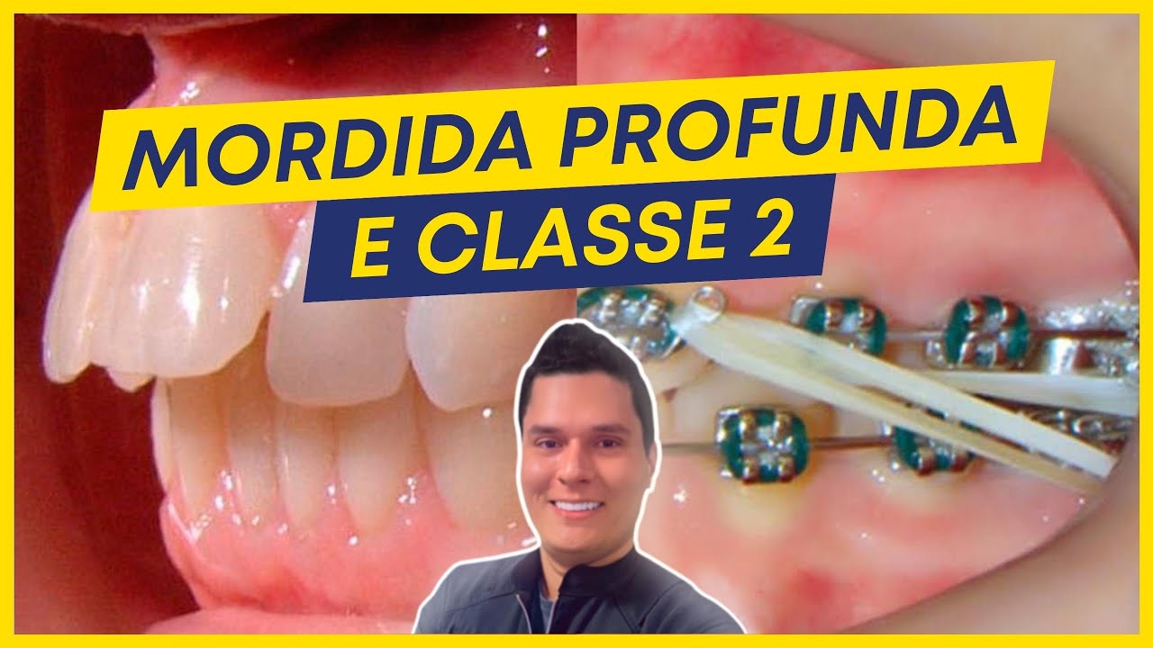 CLASSE 2 COM MORDIDA PROFUNDA - COMO TRATAR?