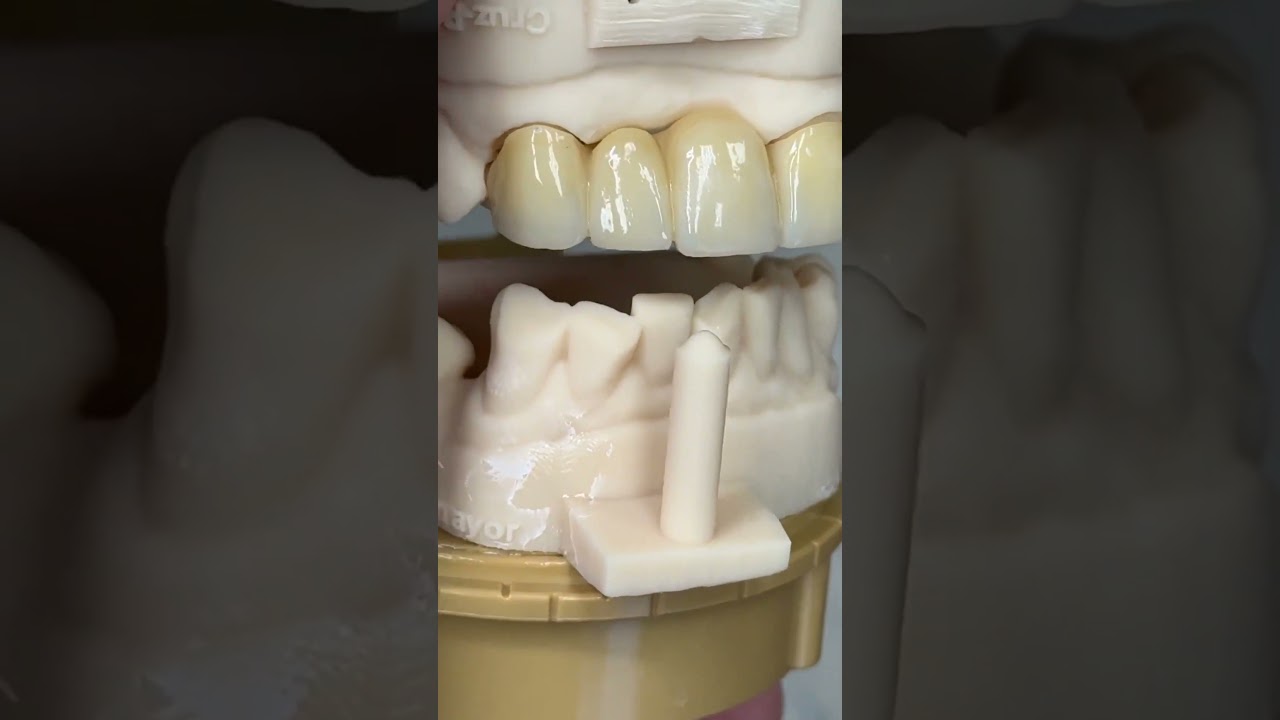 Esthetic zirconia bridge! @EnvisiontecMain #envisiontec