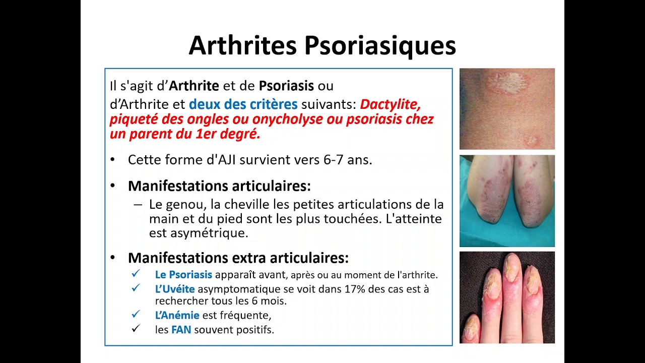 Les Arthrites Juvéniles idiopathiques - Comité pédagogique de Pédiatrie  : Docteur : Djermane