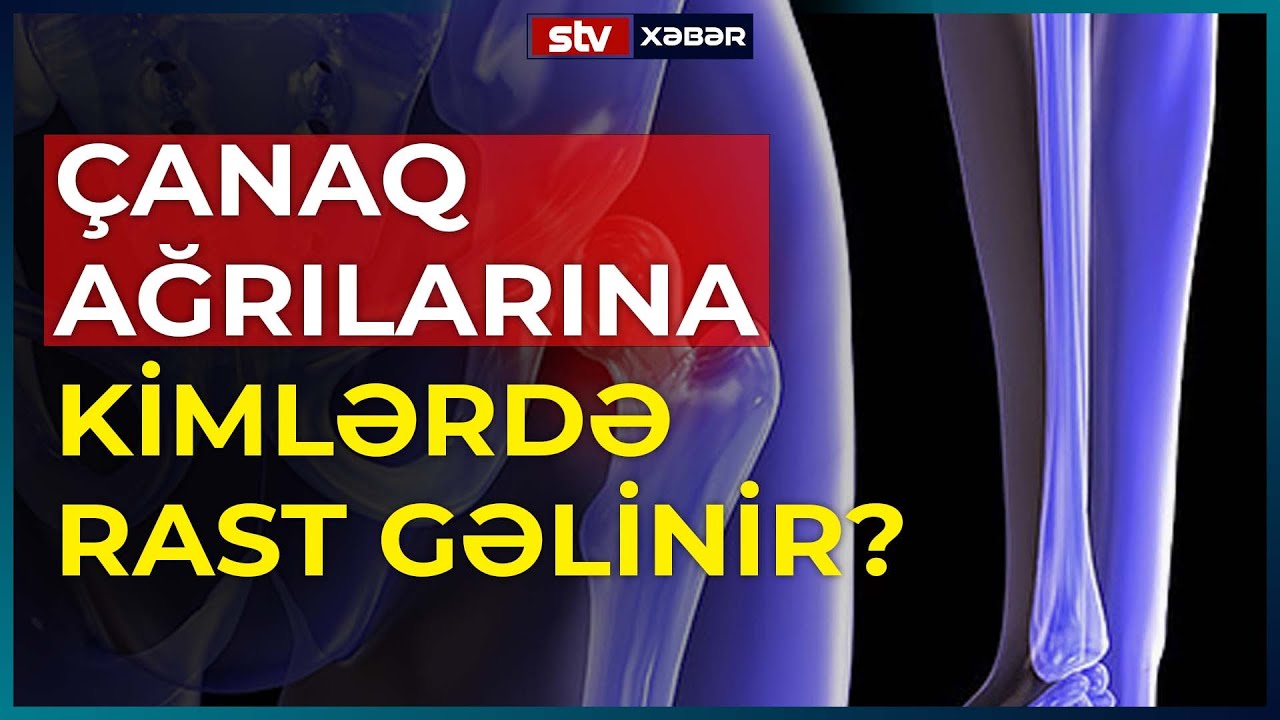 ÇANAQ AĞRILARINA KİMLƏRDƏ RAST GƏLİNİR? - STV XƏBƏR