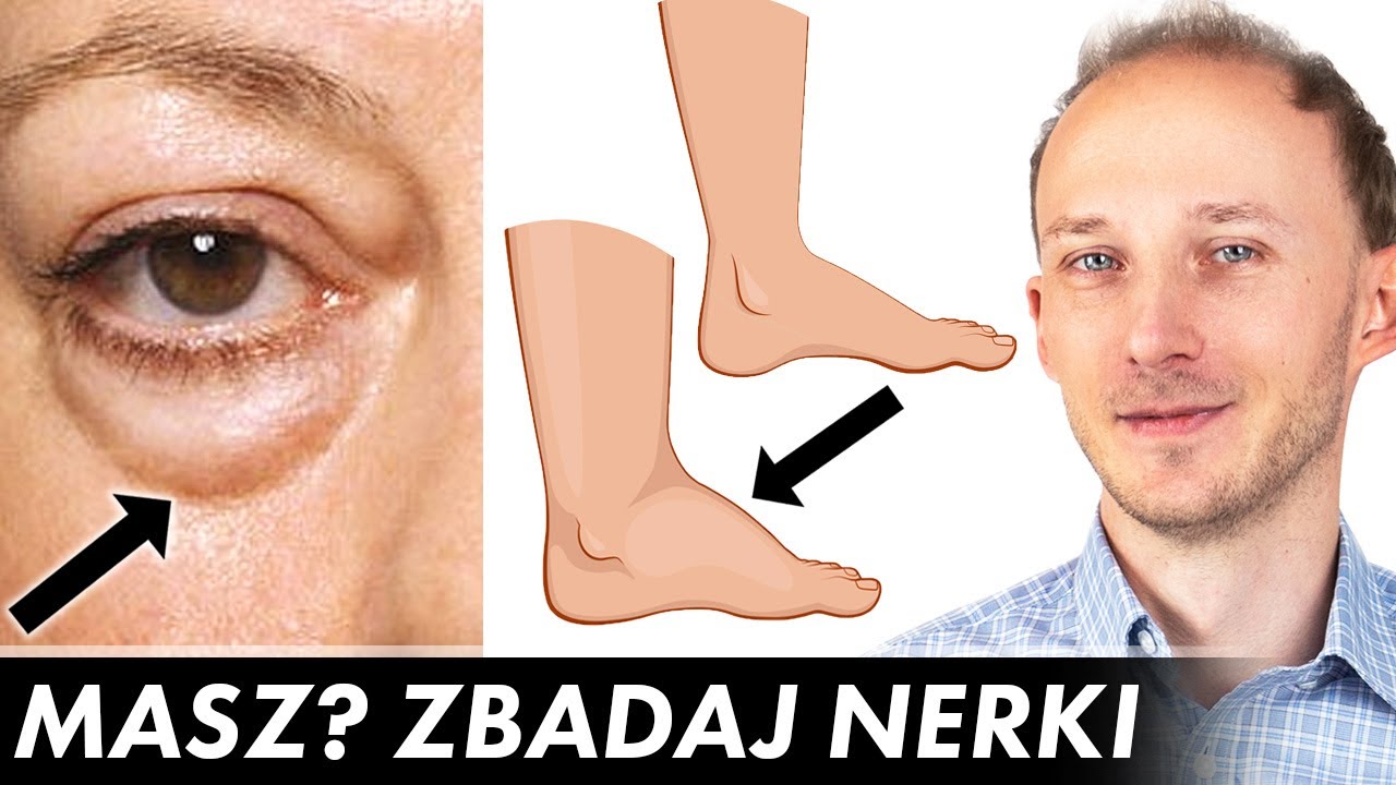 11 oznak na ciele, że czas zbadać nerki - niewydolność nerek: objawy | Dr Bartek Kulczyński