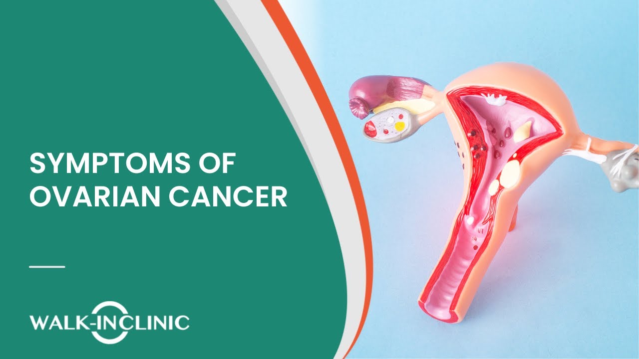 What are the symptoms of Ovarian Cancer?