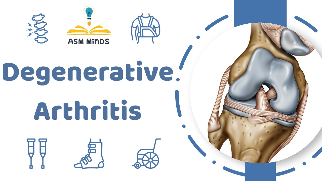 10 - Degenerative Arthritis - Orthopedics Course - By Dr.Nada Ali