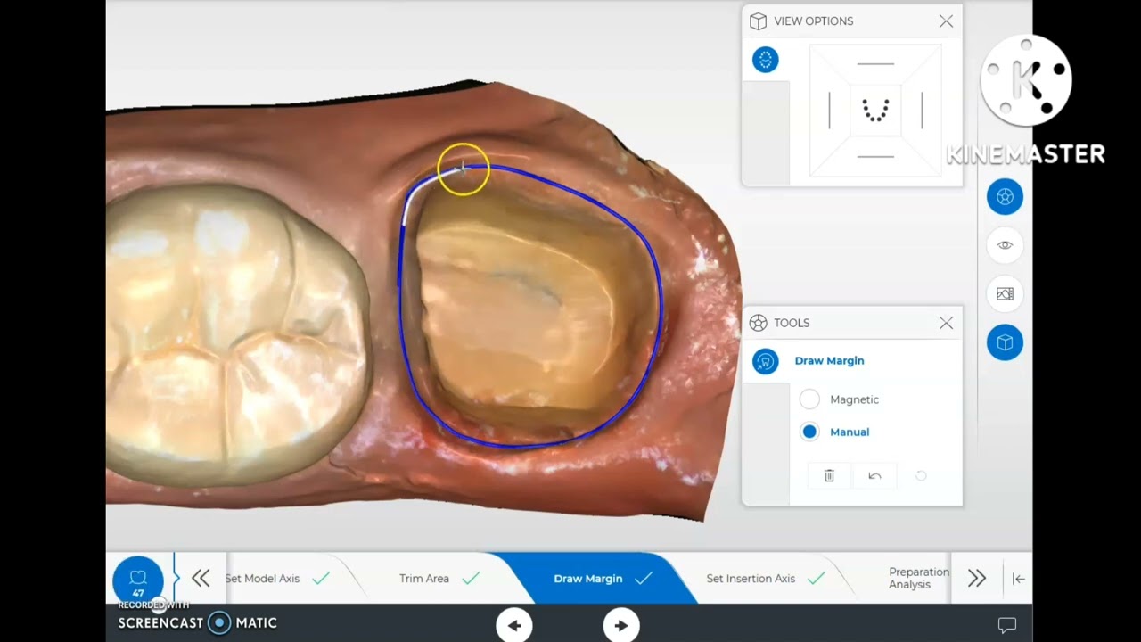 How to Design Cerec/Inlab....Lower Molar.... Tooth no. 47.....Ivoclar Zircad