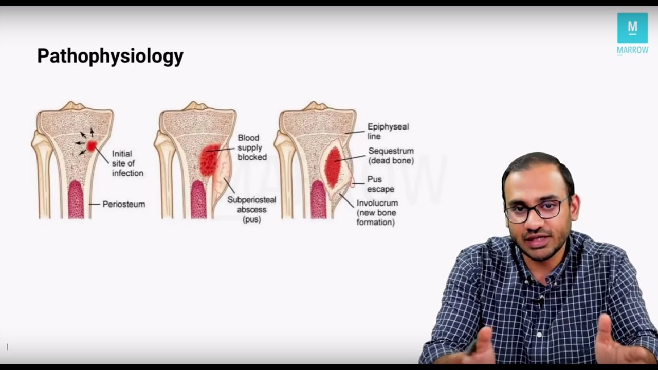 Marrow Master Classes: Orthopaedics Sample Video - Bone Infections - Pyogenic (20 mins)