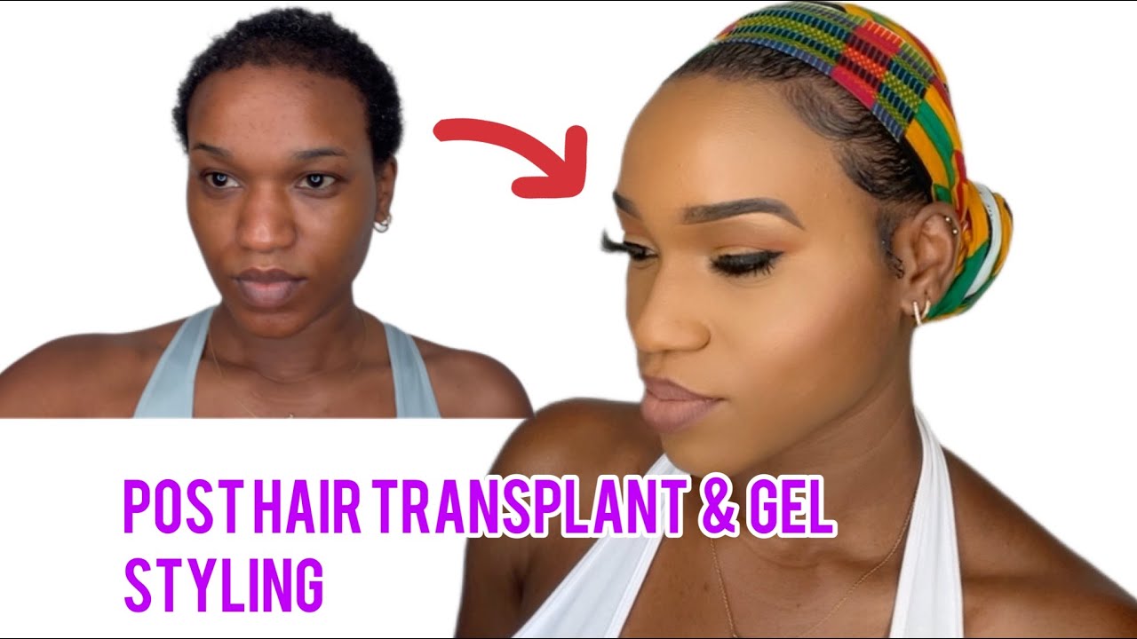 Post Afro Hair Transplant & Gel Styling