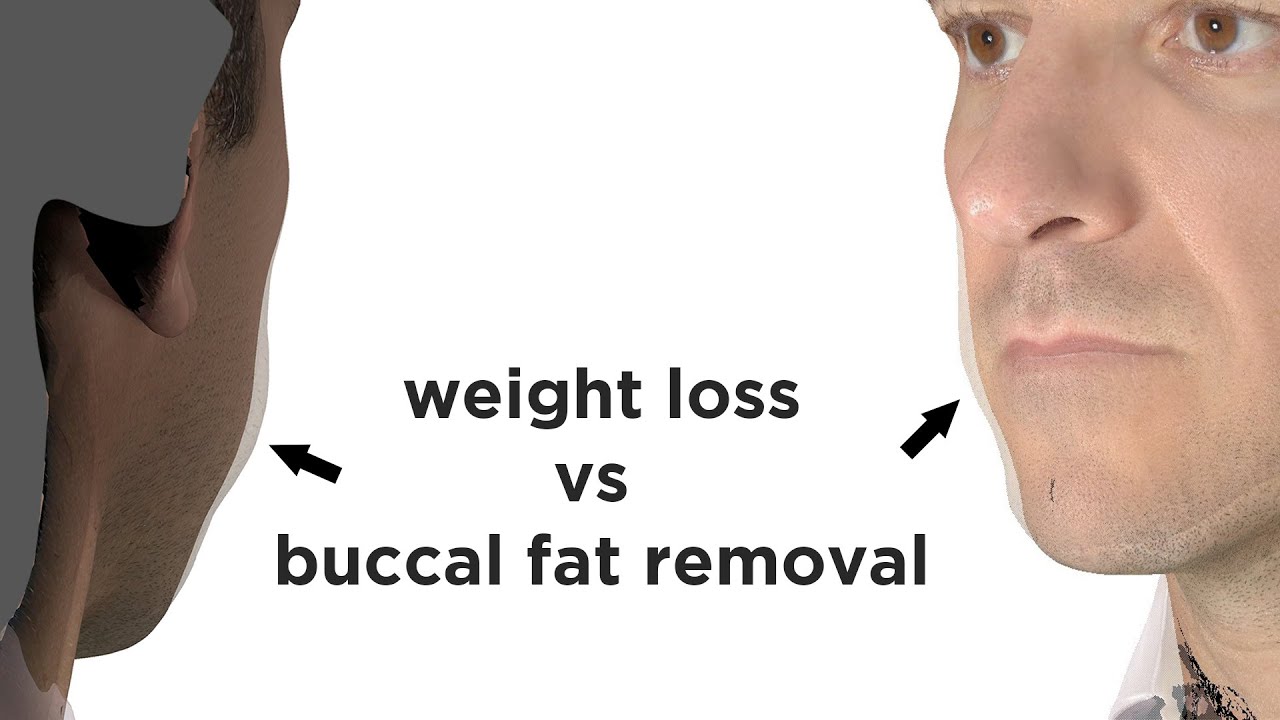 Nonsurgical Facial Slimming - Buccal Fat Reduction?  Dr. Zelken offers a surprisingly simple answer