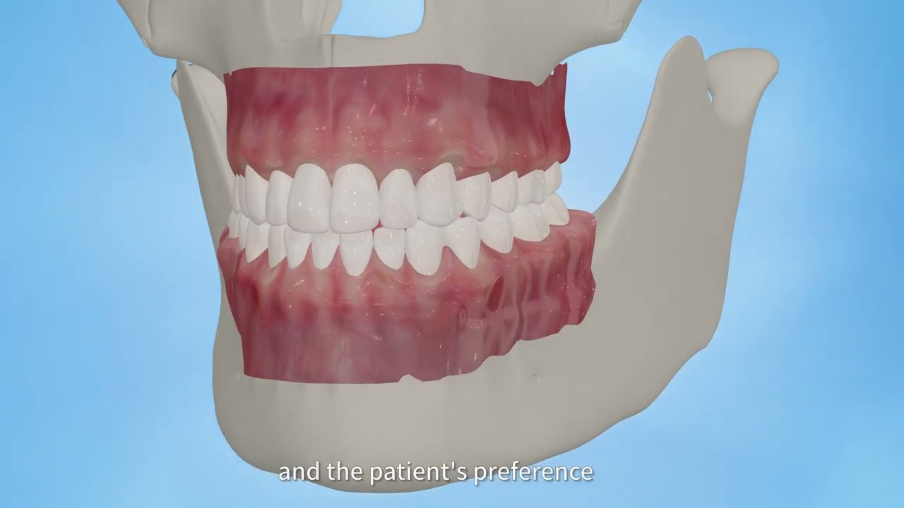 Smartee Mandibular Repositioning Staged Appliances