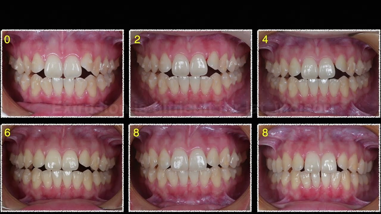 Extruding Maxillary Lateral Incisors with Clear Aligners｜【Chris Chang Ortho】555