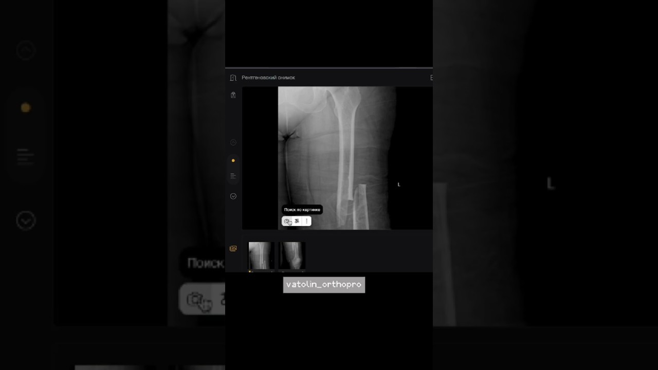 разбор кейса - перелом диафиза бедра #orthobro #orthopro