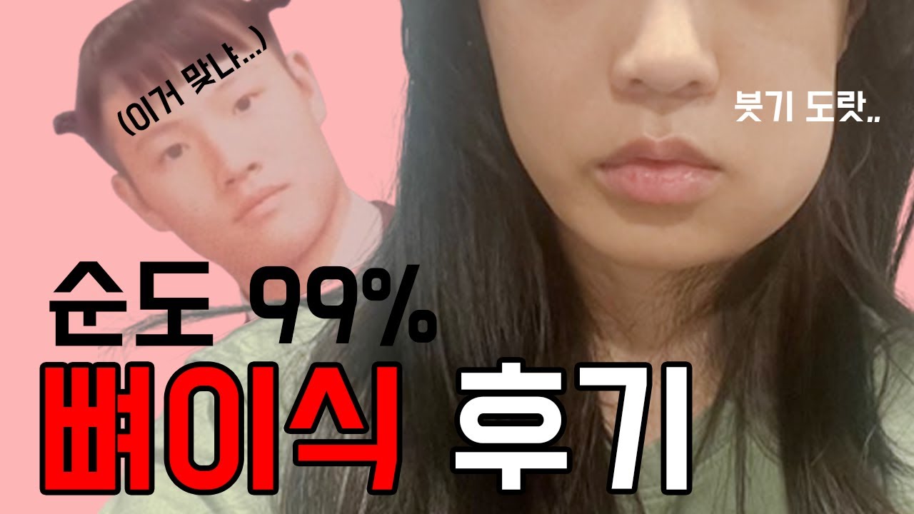재식술했던 어금니 임플란트 전 발치하고 뼈이식하기. 뼈이식 왜 이렇게 아파요...?임플란트통증