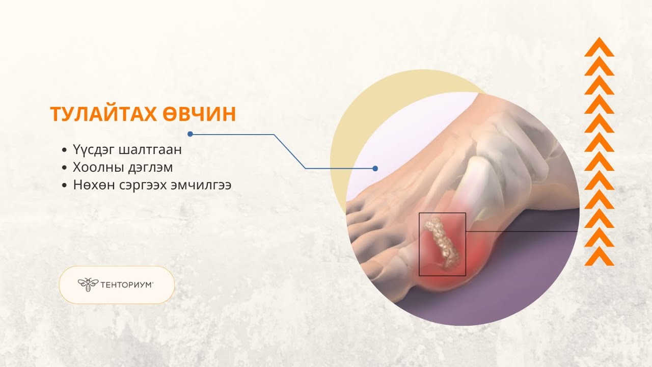 ТУЛАЙ ӨВЧИН